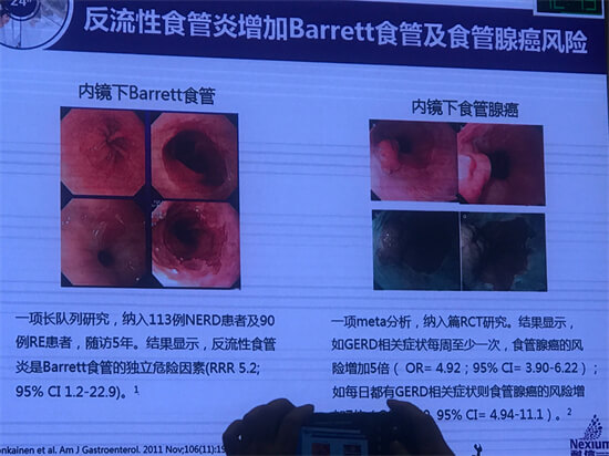 食管炎不容小觑 三大危害虎视眈眈 别等癌变才重视